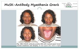 MuSK-Antibody Myasthenia Gravis
 