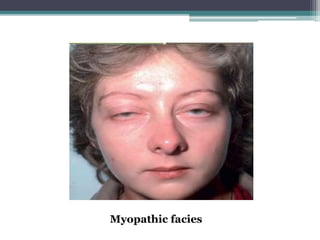 Myopathic facies
 