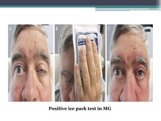 Positive ice pack test in MG
 
