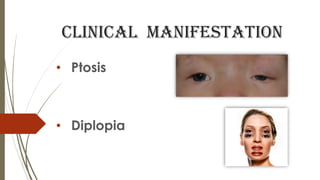 Clinical manifestation
• Ptosis
• Diplopia
 