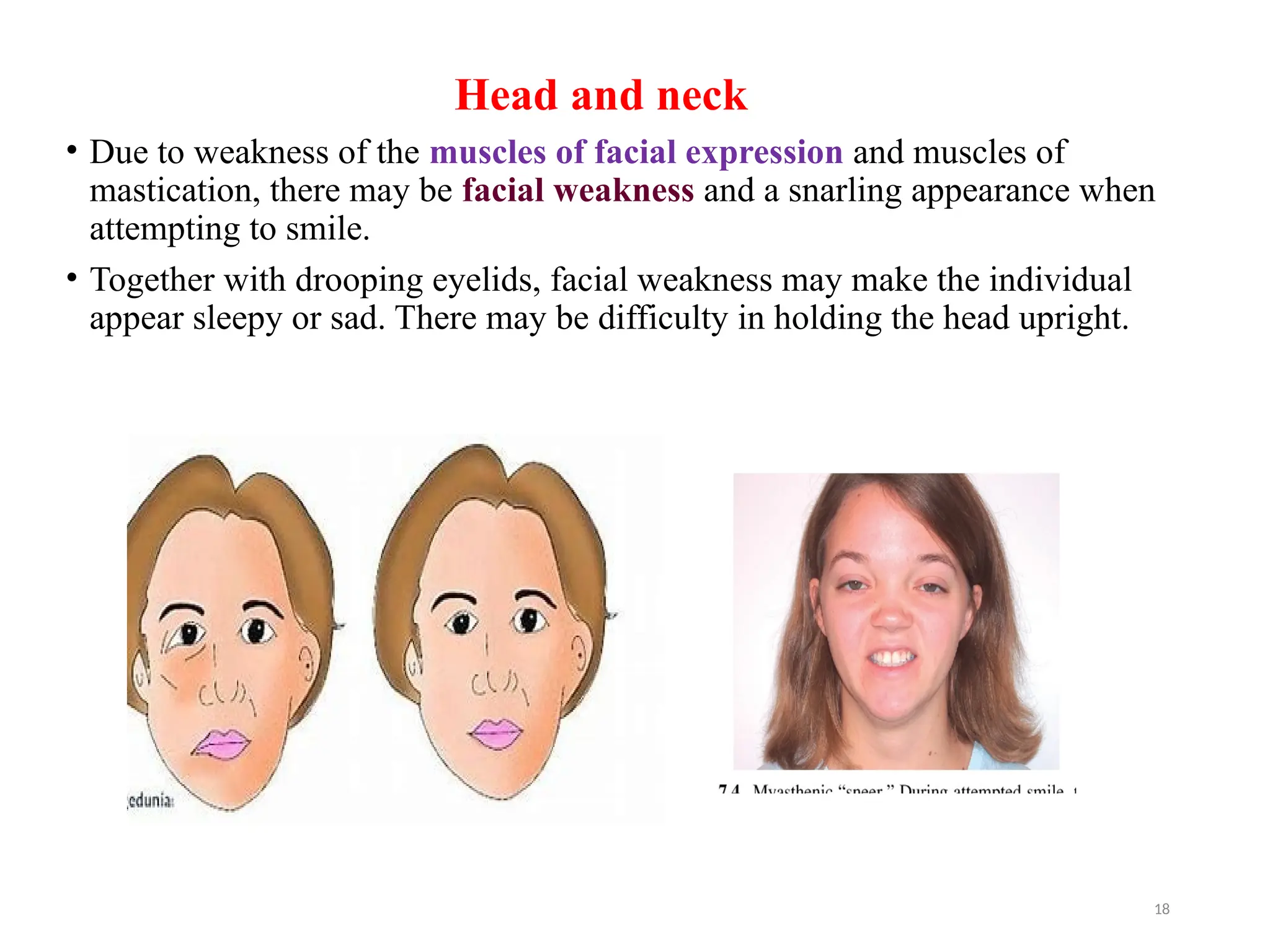 18
Head and neck
• Due to weakness of the muscles of facial expression and muscles of
mastication, there may be facial weakness and a snarling appearance when
attempting to smile.
• Together with drooping eyelids, facial weakness may make the individual
appear sleepy or sad. There may be difficulty in holding the head upright.
 