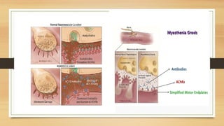 Myasthenia gravis.pptx It gives the basic outline about tha myasthenia ...