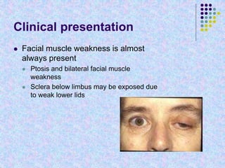 Clinical presentation
 Facial muscle weakness is almost
always present
 Ptosis and bilateral facial muscle
weakness
 Sclera below limbus may be exposed due
to weak lower lids
 