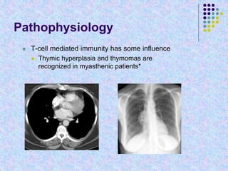 Pathophysiology
 T-cell mediated immunity has some influence
 Thymic hyperplasia and thymomas are
recognized in myasthenic patients*
 