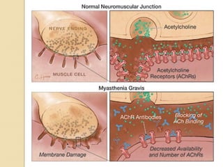 myasthenia gravis approach for diagnosis | PPT
