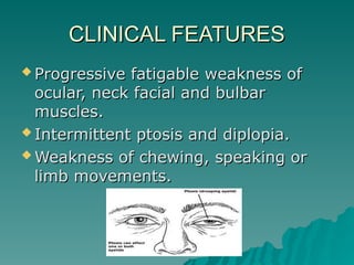 myasthenia gravis and drugs for myasthenia .ppt