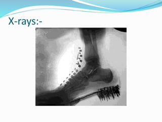 X-rays:-
 