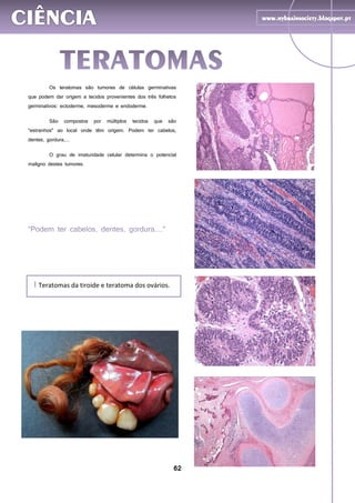 62
Teratomas da tiroide e teratoma dos ovários.I
Os teratomas são tumores de células germinativas
que podem dar origem a tecidos provenientes dos três folhetos
germinativos: ectoderme, mesoderme e endoderme.
São compostos por múltiplos tecidos que são
"estranhos" ao local onde têm origem. Podem ter cabelos,
dentes, gordura,...
O grau de imaturidade celular determina o potencial
maligno destes tumores.
São frequentes nos ovários e testículos. Podem atingir
grande volume pela acumulação de material seboso no seu
interior.
 