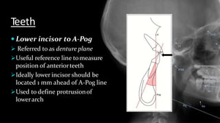 Teeth
 Lower incisor to A-Pog
 Referred to as denture plane
Useful reference line tomeasure
position of anteriorteeth
Ideally lower incisor should be
located 1 mm ahead of A-Pog line
Used to define protrusionof
lowerarch
 