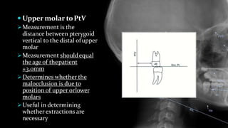  Upper molar toPtV
Measurement is the
distance between pterygoid
vertical to the distal ofupper
molar
Measurement shouldequal
the age of thepatient
+3.0mm
Determines whether the
malocclusion is due to
position of upper orlower
molars
Useful in determining
whether extractions are
necessary
 