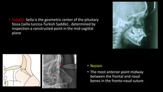 • Sella(S): Sella is the geometric center of the pituitary
fossa (sella turcica-Turkish Saddle) , determined by
inspection-a constructed point in the mid-sagittal
plane
• Nasion:
• The most anterior point midway
between the frontal and nasal
bones in the fronto-nasal suture
 