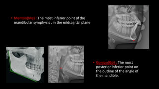 • Menton(Me) : The most inferior point of the
mandibular symphysis , in the midsagittal plane
• Gonion(Go) : The most
posterior inferior point on
the outline of the angle of
the mandible.
 