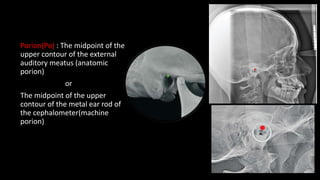 Porion(Po) : The midpoint of the
upper contour of the external
auditory meatus (anatomic
porion)
or
The midpoint of the upper
contour of the metal ear rod of
the cephalometer(machine
porion)
 