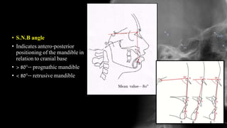 • S.N.B angle
• Indicates antero-posterior
positioning of the mandible in
relation to cranial base
• > 80°-- prognathic mandible
• < 80°-- retrusive mandible
 