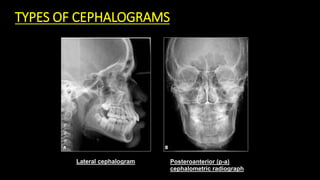 TYPES OF CEPHALOGRAMS
Posteroanterior (p-a)
cephalometric radiograph
Lateral cephalogram
 