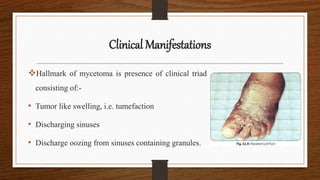 Clinical Manifestations
Hallmark of mycetoma is presence of clinical triad
consisting of:-
• Tumor like swelling, i.e. tumefaction
• Discharging sinuses
• Discharge oozing from sinuses containing granules.
 