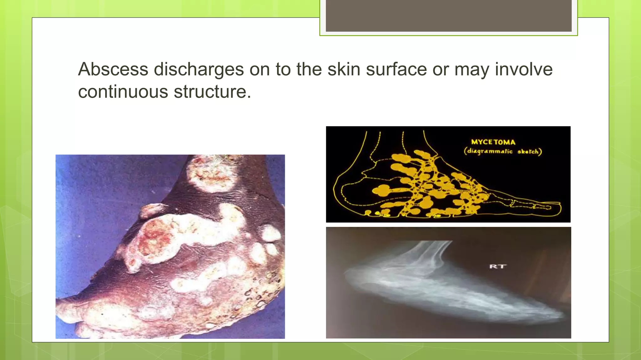 Abscess discharges on to the skin surface or may involve
continuous structure.
 