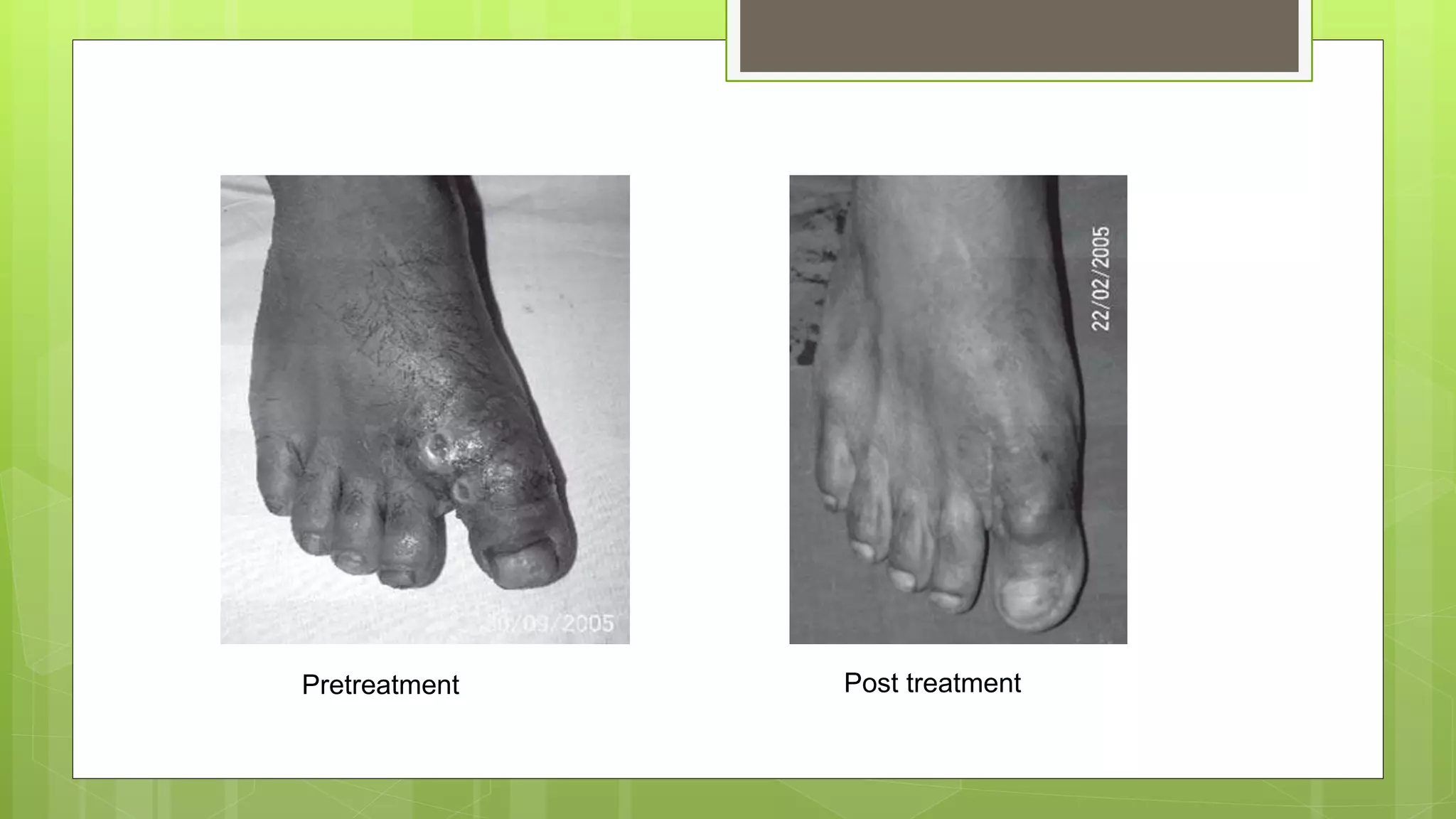 Pretreatment Post treatment
 