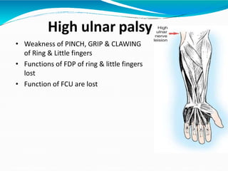 High ulnar palsy
• Weakness of PINCH, GRIP & CLAWING
of Ring & Little fingers
• Functions of FDP of ring & little fingers
lost
• Function of FCU are lost
 