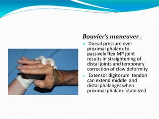 Bouvier’s maneuver :
 Dorsal pressure over
proximal phalanx to
passively flex MP joint
results in straightening of
distal joints and temporary
correction of claw deformity
 Extensor digitorum tendon
can extend middle and
distal phalangeswhen
proximal phalanx stabilized
 