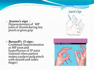  Jeanne’s sign :
Hyperextension of MP
jointof thumbduring key
pinch orgross grip
 Bunnell’s O sign :
Combined hyperextension
at MP jointand
hyperflexion of IP joint
(noticed when patient
makesa pulp to pulp pinch
with thumb and index
finger)
 