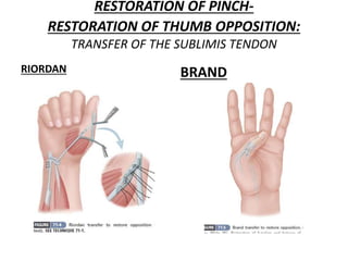 RESTORATION OF PINCH-
RESTORATION OF THUMB OPPOSITION:
TRANSFER OF THE SUBLIMIS TENDON
RIORDAN BRAND
 