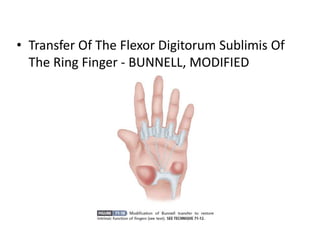 • Transfer Of The Flexor Digitorum Sublimis Of
The Ring Finger - BUNNELL, MODIFIED
 