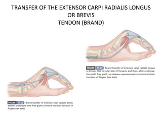 TRANSFER OF THE EXTENSOR CARPI RADIALIS LONGUS
OR BREVIS
TENDON (BRAND)
 