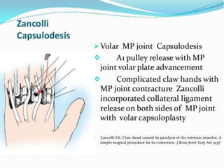 CAPSULODESIS
ZANCOLLI
 