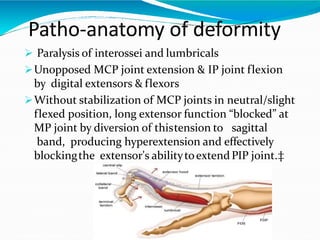 Patho-anatomy of deformity
 Paralysis of interossei and lumbricals
Unopposed MCP joint extension & IP joint flexion
by digital extensors & flexors
Without stabilization of MCP joints in neutral/slight
flexed position, long extensor function “blocked” at
MP joint by diversion of thistension to sagittal
band, producing hyperextension and effectively
blockingthe extensor's abilitytoextendPIP joint.‡
 