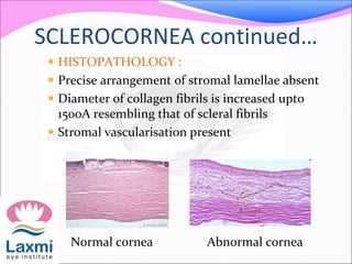 SCLEROCORNEA continued…
 HISTOPATHOLOGY :
 Precise arrangement of stromal lamellae absent
 Diameter of collagen fibrils is increased upto
1500A resembling that of scleral fibrils
 Stromal vascularisation present
Normal cornea Abnormal cornea
 