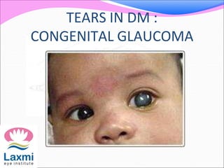 TEARS IN DM :
CONGENITAL GLAUCOMA
 