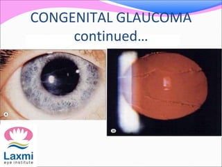 CONGENITAL GLAUCOMA
continued…
 