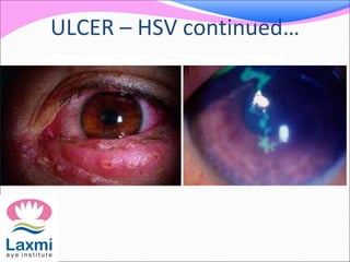 ULCER – HSV continued…
 