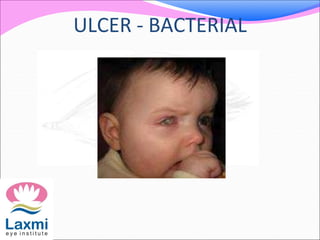 ULCER - BACTERIAL
 