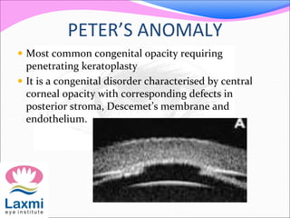 PETER’S ANOMALY
 Most common congenital opacity requiring
penetrating keratoplasty
 It is a congenital disorder characterised by central
corneal opacity with corresponding defects in
posterior stroma, Descemet’s membrane and
endothelium.
 
