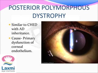 POSTERIOR POLYMORPHOUS
DYSTROPHY
 Similar to CHED
with AD
inheritance.
 Cause- Primary
dysfunction of
corneal
endothelium.
 
