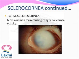 SCLEROCORNEA continued…
 TOTAL SCLEROCORNEA:
Most common form causing congenital corneal
opacity.
 
