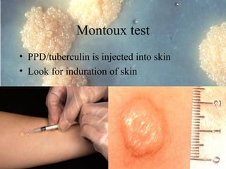 Montoux test
• PPD/tuberculin is injected into skin
• Look for induration of skin

Dr. Ashish V. Jawarkar

 