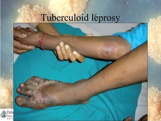 Tuberculoid leprosy

Dr. Ashish V. Jawarkar

 