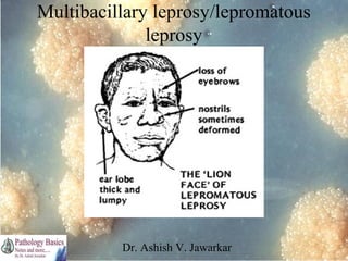 Multibacillary leprosy/lepromatous
leprosy

Dr. Ashish V. Jawarkar

 