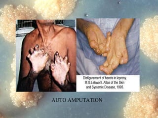 AUTO AMPUTATION
Dr. Ashish V. Jawarkar

 