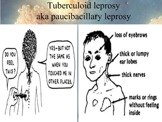 Tuberculoid leprosy
aka paucibacillary leprosy

Dr. Ashish V. Jawarkar

 