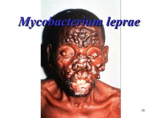 20 
MMyyccoobbaacctteerriiuumm lleepprraaee 
 