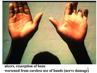 uullcceerrss,, rreessoorrppttiioonn ooff bboonnee 
wwoorrsseenneedd ffrroomm ccaarreelleessss uussee ooff hhaannddss ((nneerrvvee ddaammaaggee)) 
22 
 