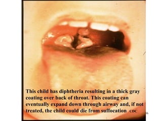 36 
This child has diphtheria resulting in a thick gray 
coating over back of throat. This coating can 
eventually expand down through airway and, if not 
treated, the child could die from suffocation CDC 
 