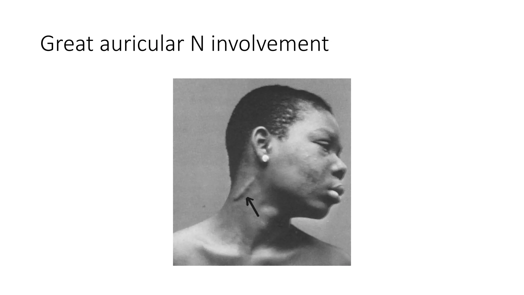 Great auricular N involvement
 