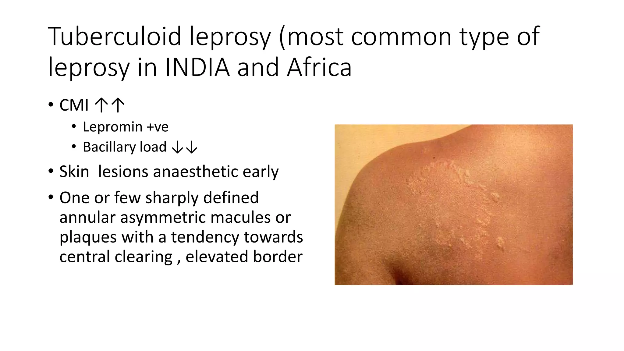 Tuberculoid leprosy (most common type of
leprosy in INDIA and Africa
• CMI ↑↑
• Lepromin +ve
• Bacillary load ↓↓
• Skin lesions anaesthetic early
• One or few sharply defined
annular asymmetric macules or
plaques with a tendency towards
central clearing , elevated border
 