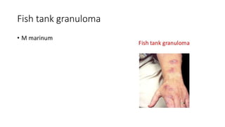 Fish tank granuloma
• M marinum
 
