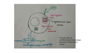• Virchows cells are
undifferentiated macrophages
• Abundant in lepromatous
leprosy
 